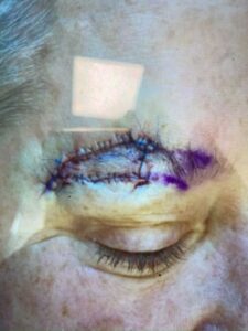 Skin cancer and aging resulted in a Mohs surgery for me.